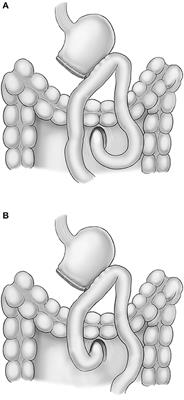 Comparison of the Clinical Outcomes Between Isoperistaltic and Antiperistaltic Anastomoses After Laparoscopic Distal Gastrectomy for Patients With Gastric Cancer